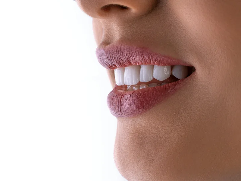 Primer plano de una sonrisa con los dientes blancos después del tratamiento