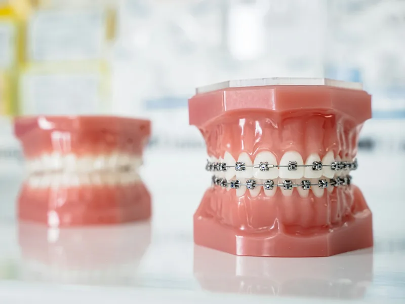 Modelo de arcada dental con brackets metálicos y con alineador transparente